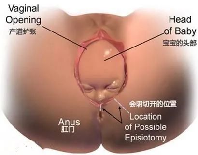 侧切技术,产后侧切45天后大便有点血