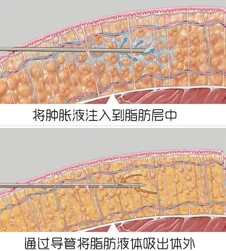 抽出来的脂肪为什么是液体,抽出来的脂肪去哪里了
