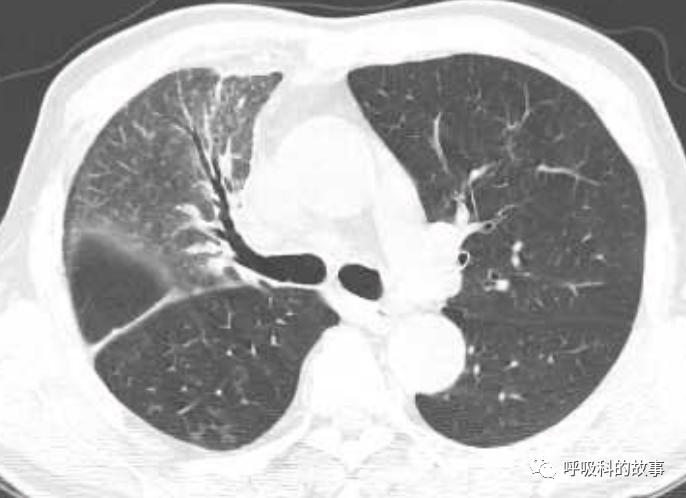 我是如何诊治肺炎的？（4）——如何理解抓住关键信息（2）