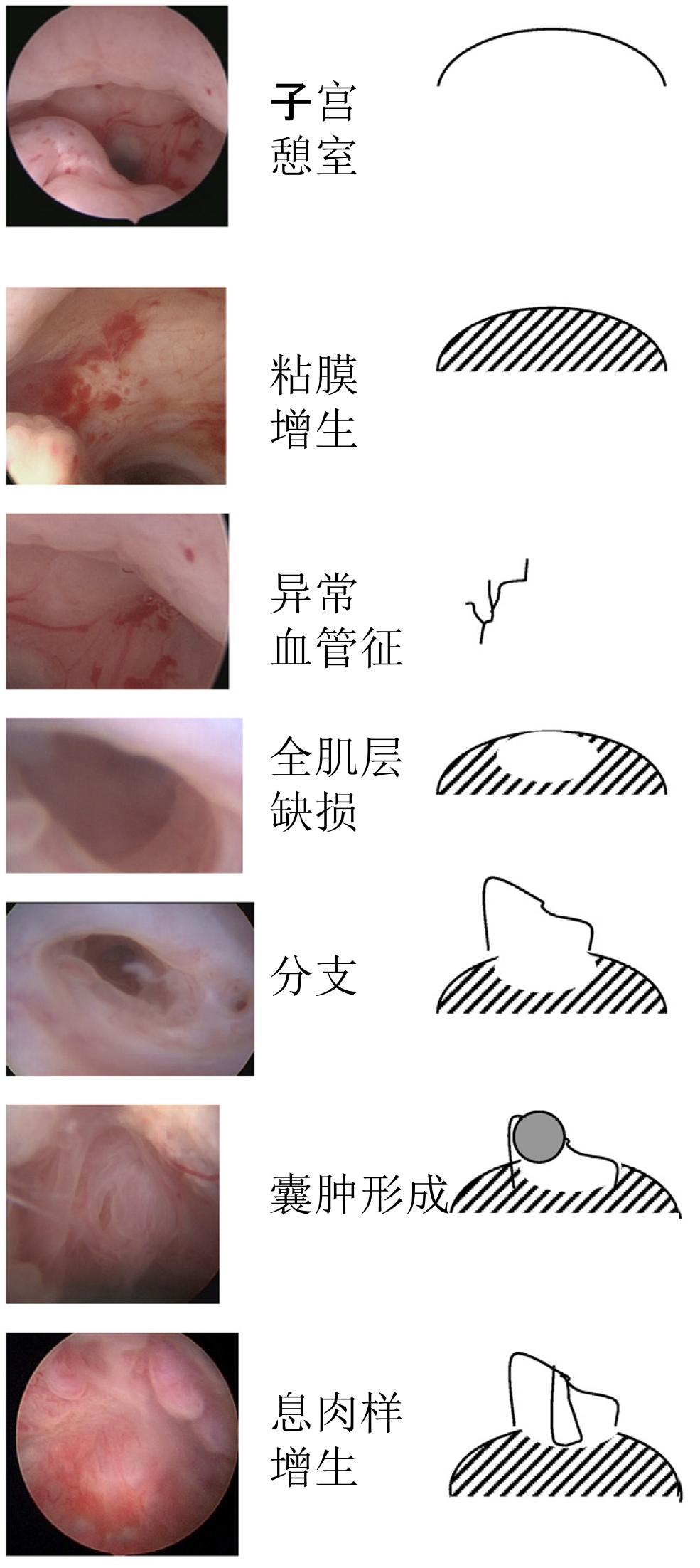 剖宫产术后有多少人有憩室,剖宫产后再次妊娠顺产大出血概率