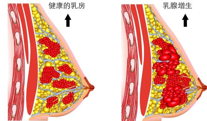 如何快速丰胸且不会反弹,不吃药怎么丰胸