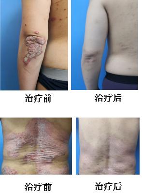 银屑病能用激光去除吗,银屑病能刮掉皮屑吗