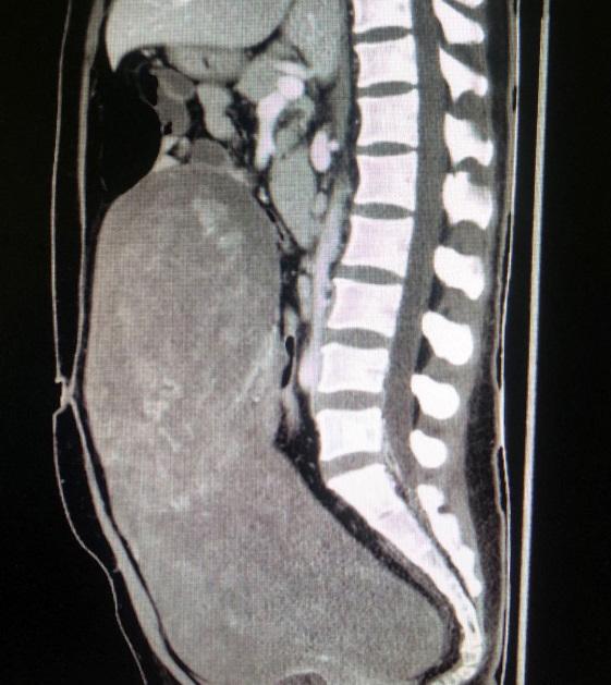 妙手神医变身“拆弹专家”北京友谊医院成功切除13斤巨大盆腹腔肿瘤