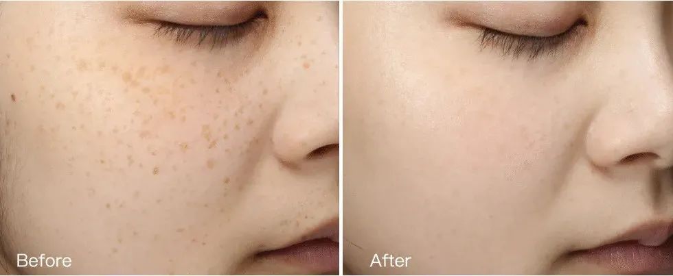 花了3万做激光，才彻底懂了：医生为什么劝你别去斑