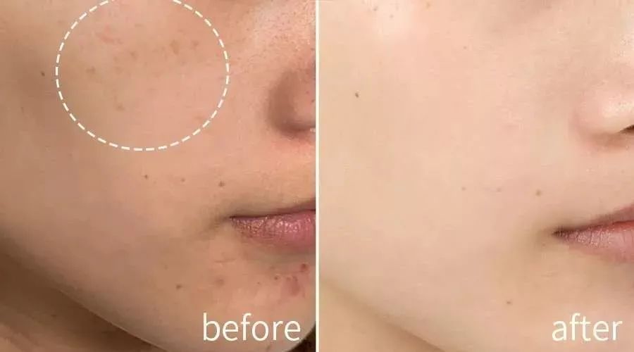 花了3万做激光，才彻底懂了：医生为什么劝你别去斑