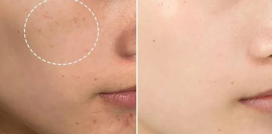 花了3万做激光,才彻底懂了:医生为什么劝你别去斑