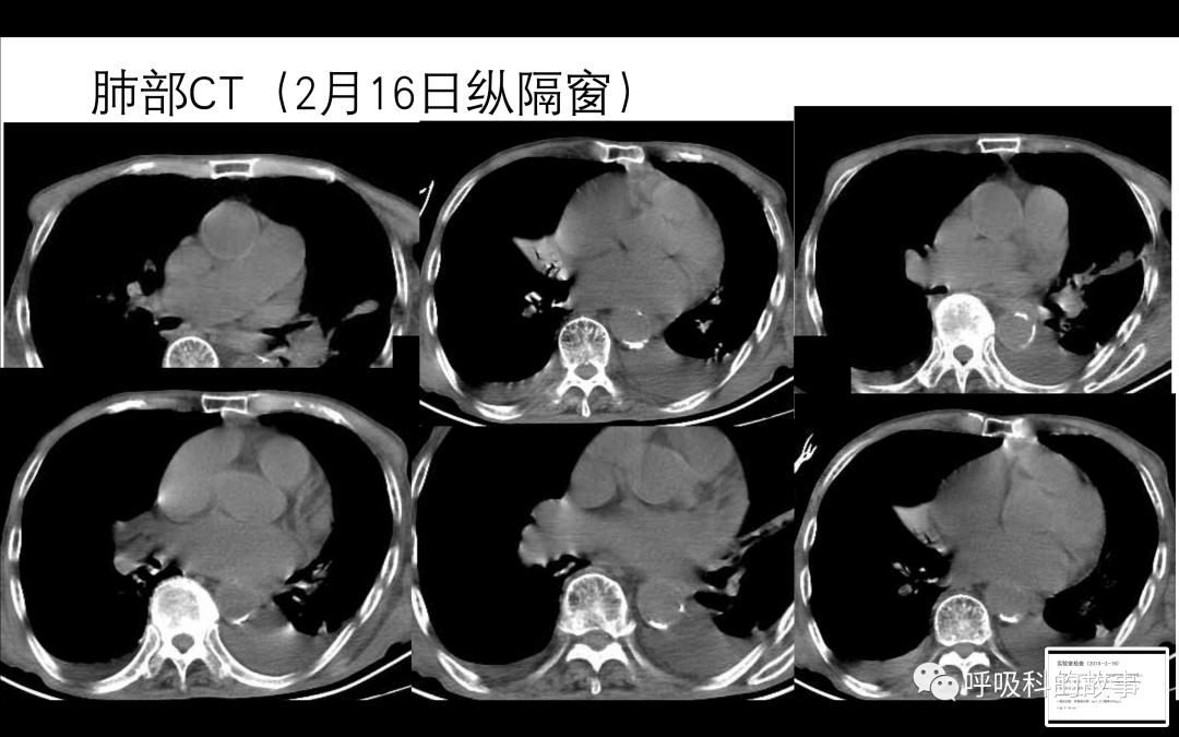 痰液微生物培养注意事项,痰液细菌培养及药敏试验结果