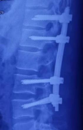 兰大二院骨科与神经外科联合成功实施罕见脊髓圆锥畸胎瘤手术