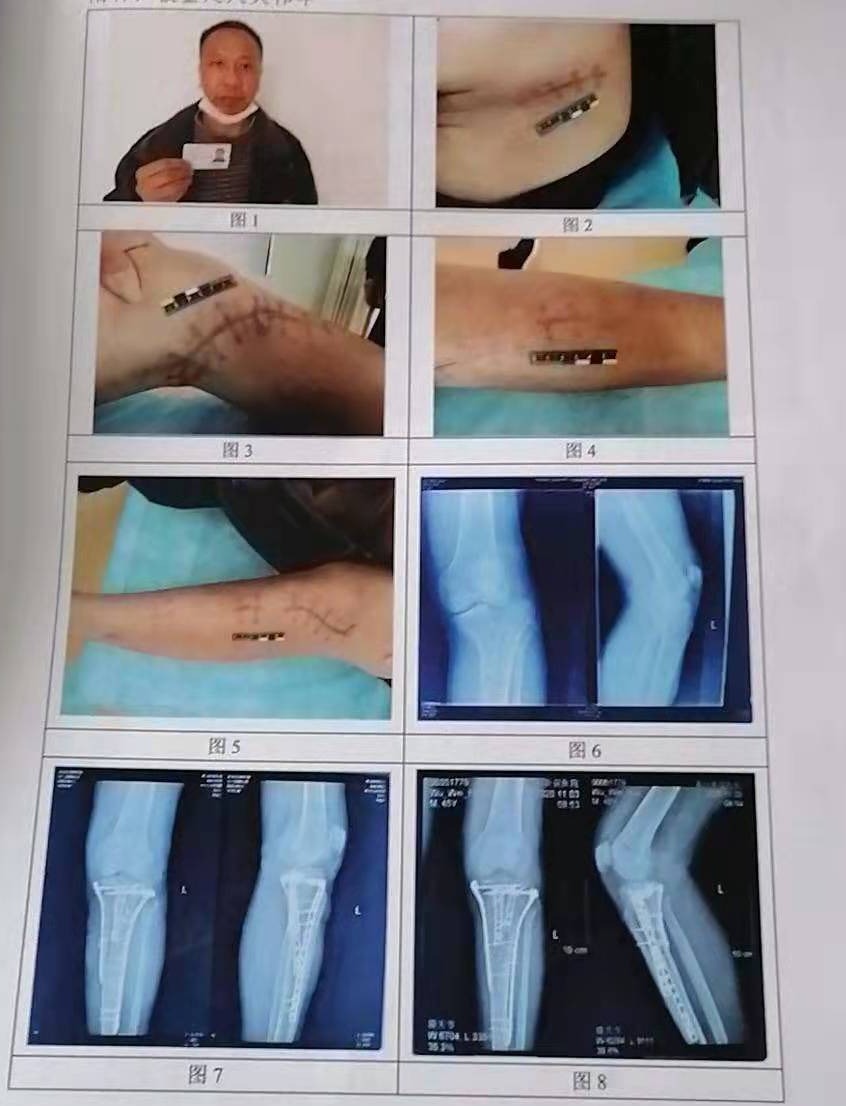 外卖小哥工伤理赔,外卖骑手受伤怎么找平台赔付工伤