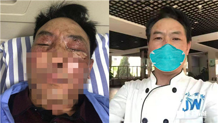 惊险!昆明一男子用强碱疏通下水道碱水入眼烧伤角膜