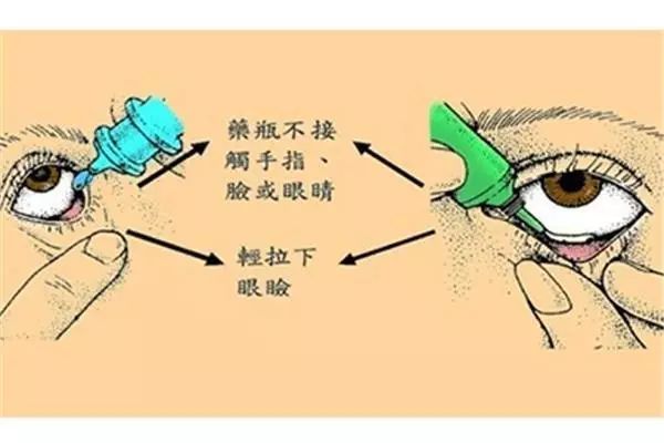 药店人必看：8类眼疾用药