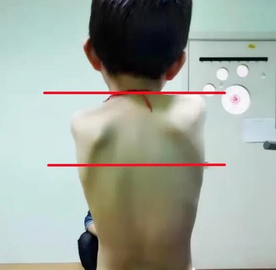 孩子驼背富贵包脊柱侧弯怎么矫正,孩子高低肩总驼背