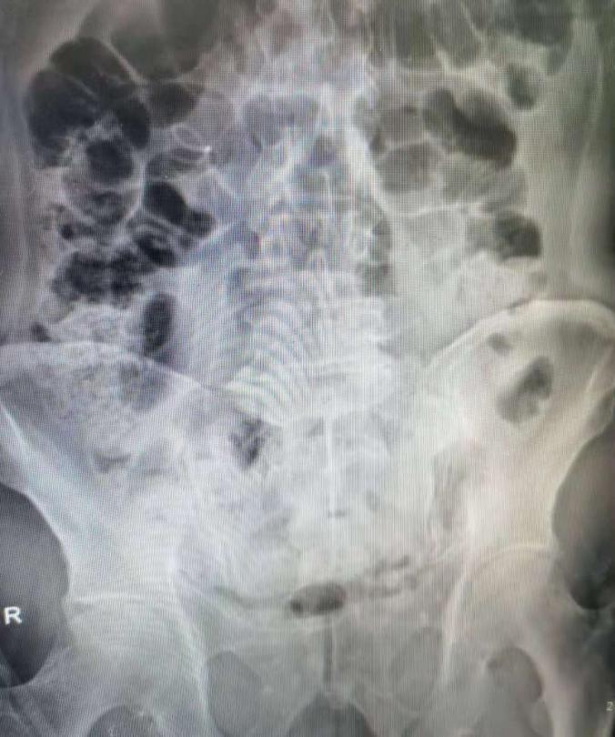 兰大二院泌尿外科住院部,经皮肾镜碎石取石术最新研究进展