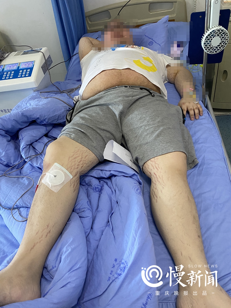 慢新闻-健康|30岁男子滥用国外痛风药，体重暴涨80斤、肚子上长紫纹