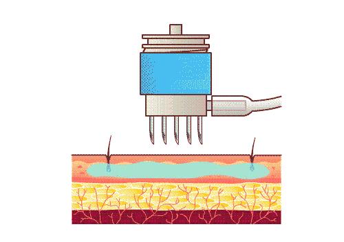几百块和几千块的水光针，到底差在哪？
