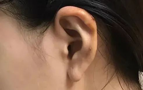 打耳洞打出个肉疙瘩,打耳洞长出肉疙瘩的概率多大
