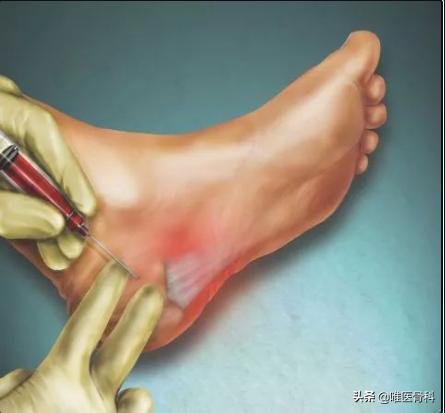 足底受力疼早上起床明显发作反复,足底痛一招教你解决