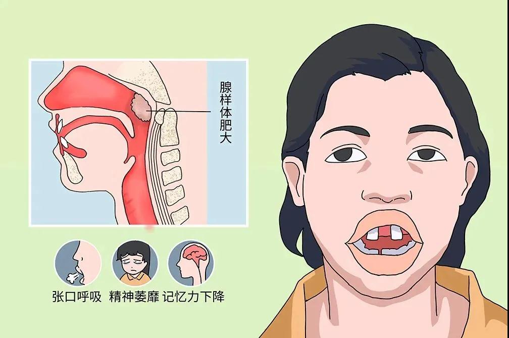 省中医看腺样体肥大哪个医生最好,儿童腺样体重度肥大的危害