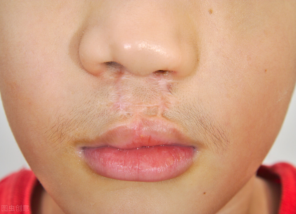 唇炎中药怎么治疗才能彻底除根,中药治疗唇炎要多久