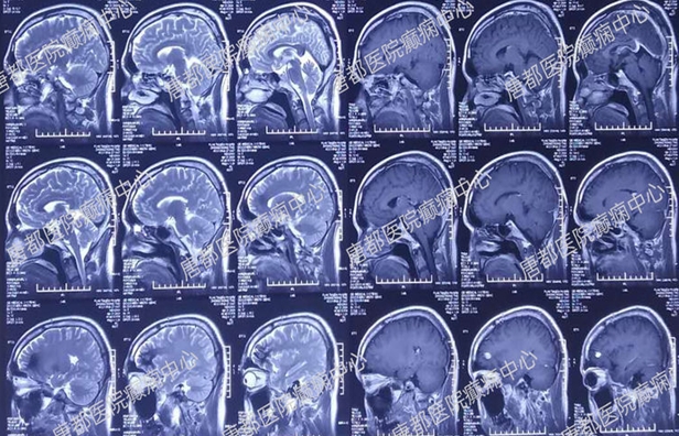 颞叶海绵状血管瘤癫痫微创手术,唐都医院脑肿瘤微创手术