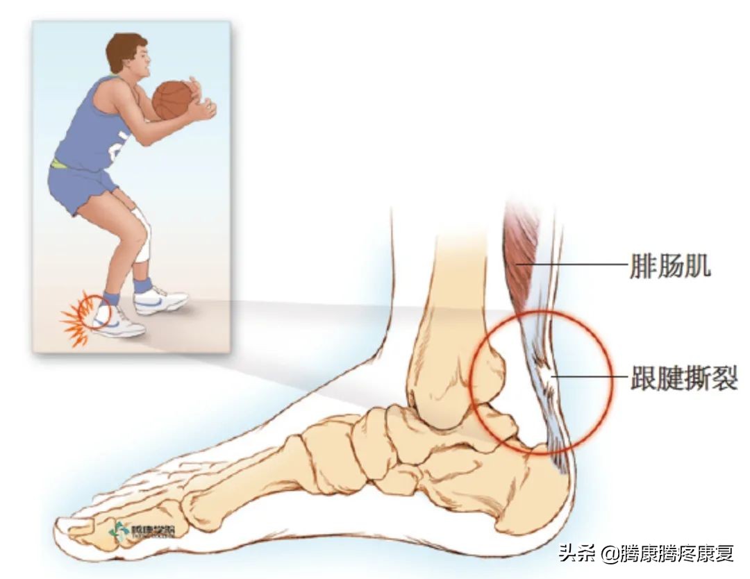 跟腱炎诊疗计划,跟腱炎四个痛点
