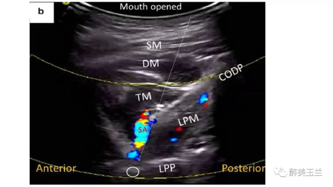 病例分享丨三叉神经节微球囊压迫术的麻醉管理
