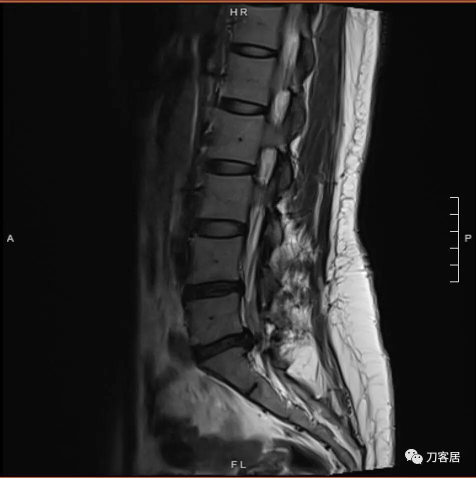 椎间孔镜微创手术13天,椎间孔镜微创手术患者