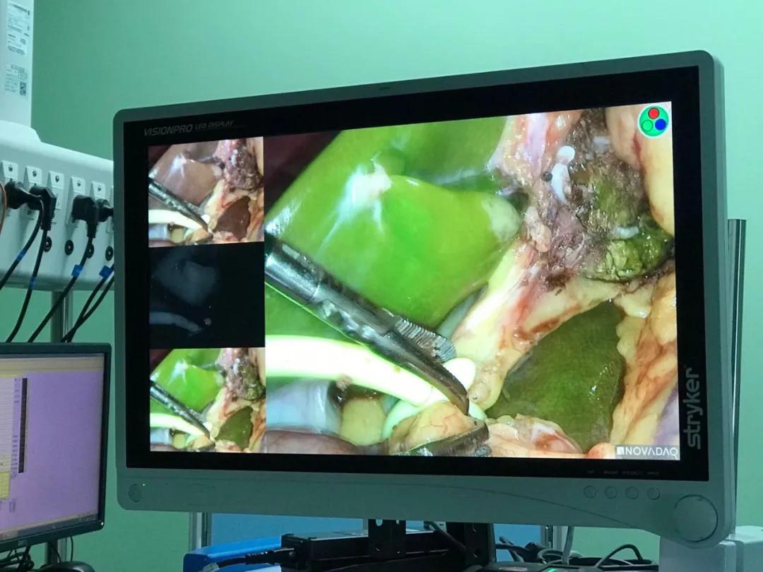 腹腔镜下肝切除适应症,腹腔镜肝左叶血管瘤切除术