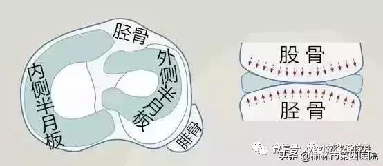 内侧半月板后角损伤怎么治疗,prp治疗半月板损伤有用吗