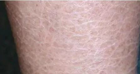 脚后跟干裂粗糙是脾胃不和吗,脚后跟干裂皮肤缺水