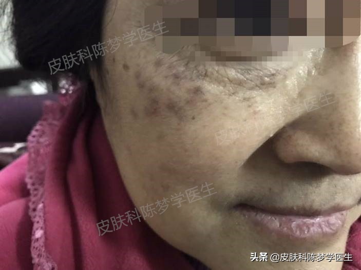 褐青色雀斑多久能治好,脸上起褐斑怎么治效果快