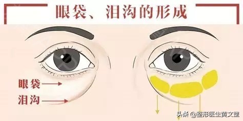 有了泪沟怎么消除,改善显老泪沟试试这3种方法