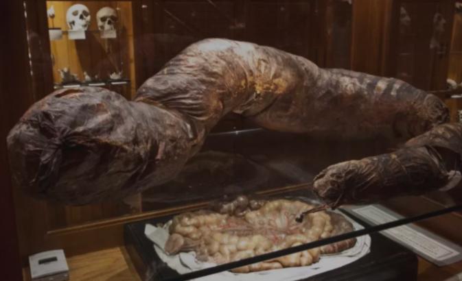 英国男子便秘28年不上厕所,英国男子3年未排便