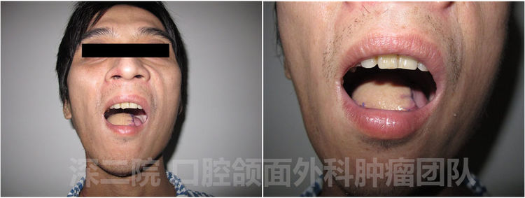 舌癌患者的守护神—深圳市第二人民医院口腔颌面外科肿瘤团队