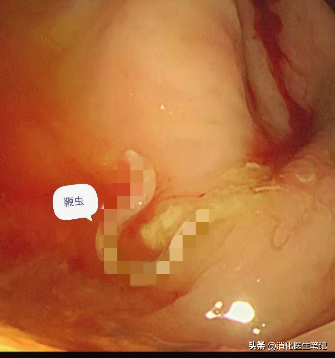 老年人肠胃镜检查,65岁老人胃肠镜检查