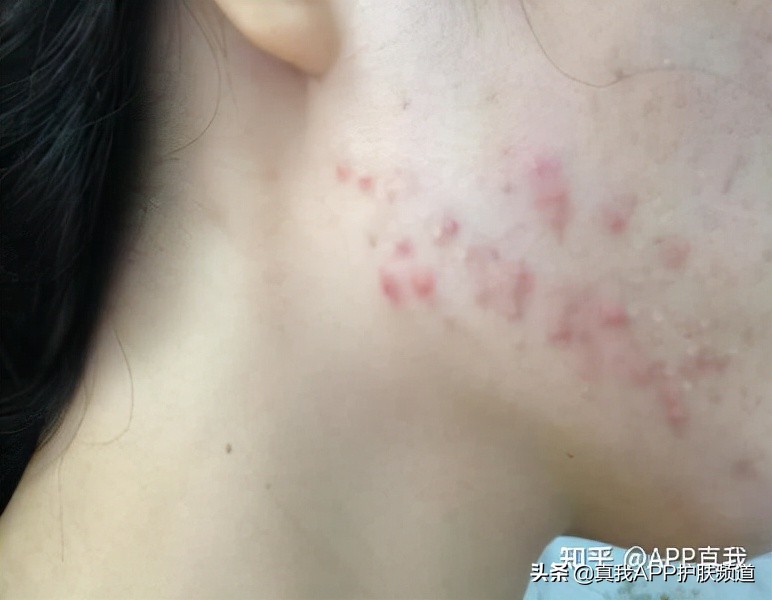 强效去黑头方法,去黑头大科普教你正确去黑头