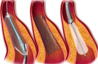 心肌缺血引起心绞痛怎么办,心肌缺血引起的心绞痛怎么治疗