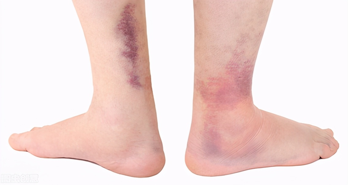 有些人身上无缘无故有淤青,有些人身上总出现淤青怎么回事