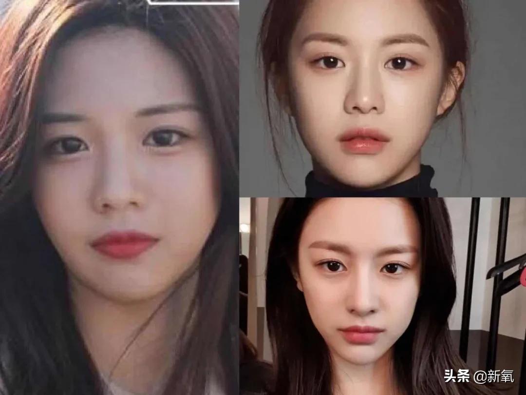 脸松弛下垂做哪种整形,面部下垂整形方法