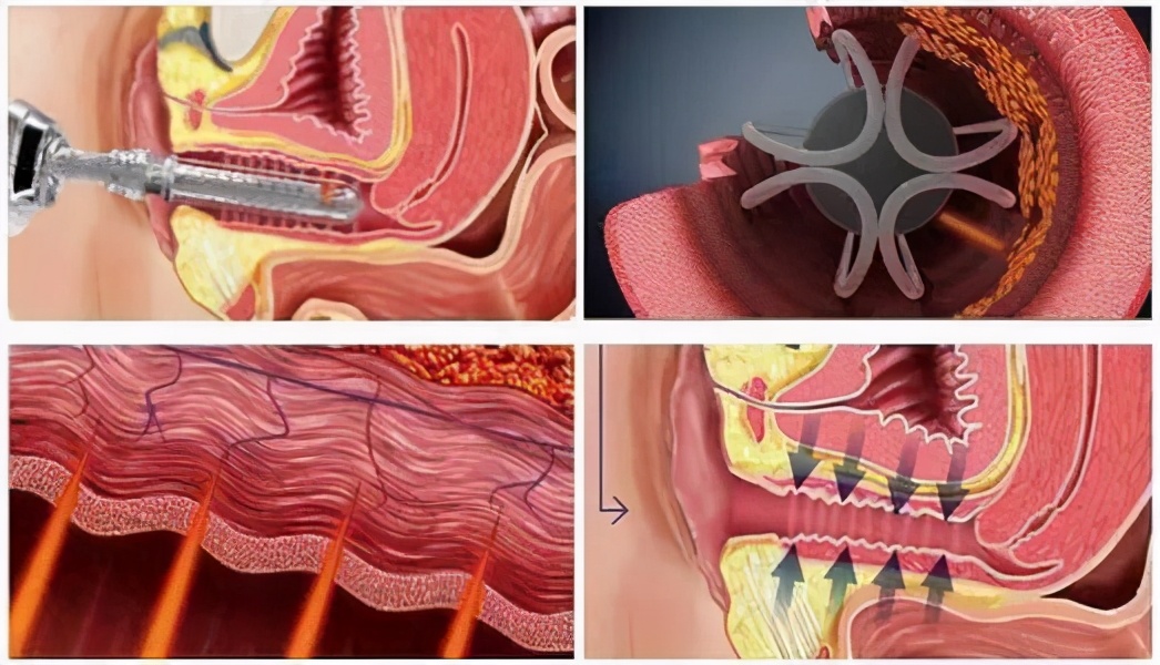 不做手术也能实现阴道紧缩吗？