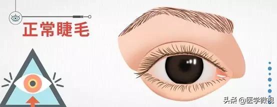 睫毛长倒睫怎么办,睫毛倒长扎眼睛怎么处理
