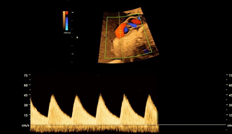 腹中胎儿长出肿瘤，孕妇忍着剧痛，给胎儿打麻药做手术