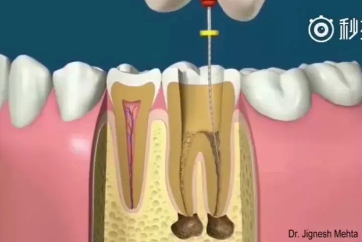 有蛀牙但没时间做根管怎么办,蛀牙多严重做根管