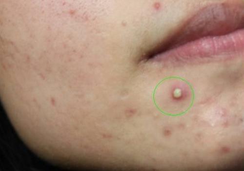 30多岁了脸上还是长痘痘反反复复,脸上反反复复长痘痘是怎么回事
