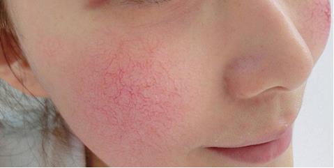 皮肤敏感肌全脸干脱皮,脸部泛红刺痛脱皮敏感肌怎么保湿