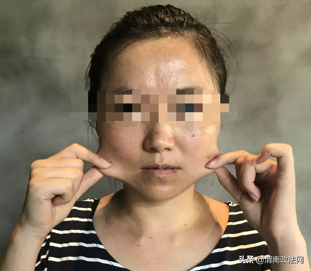 一女子打瘦脸针毁容,瘦脸针毁容