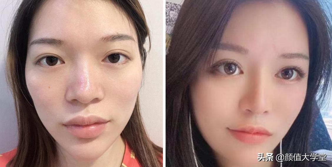 凸嘴有什么方法改善,形成嘴凸的原因