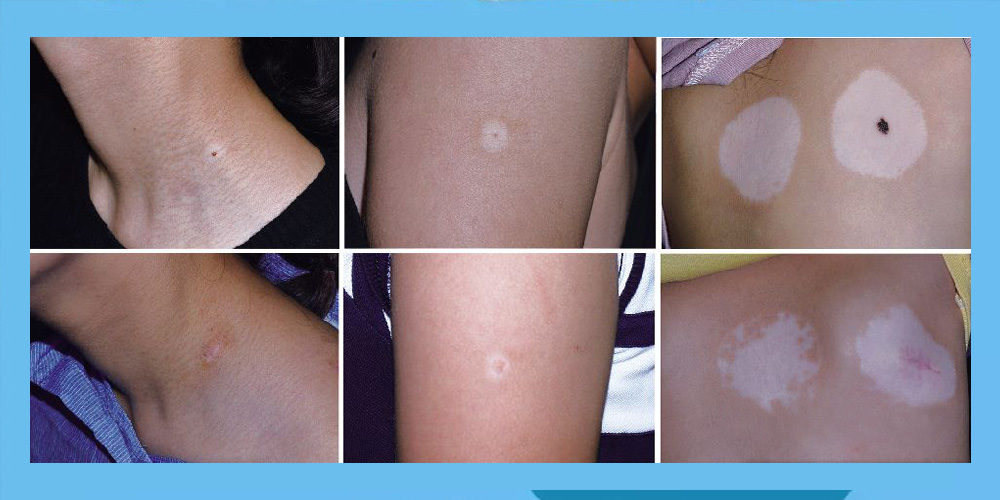 晕痣和晕痣型白癜风有什么区别,晕痣是什么颜色的