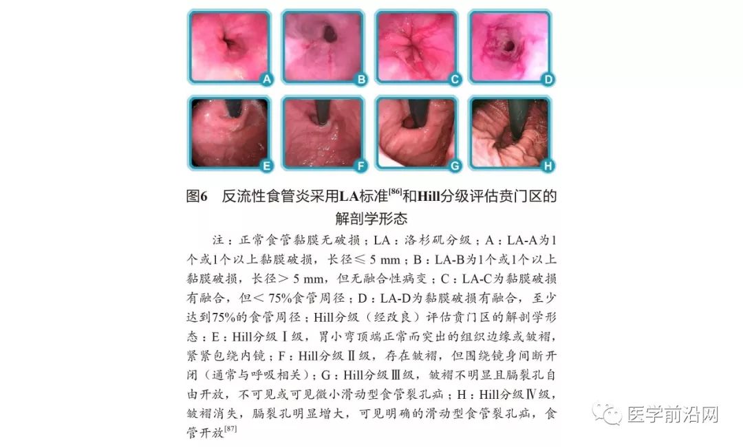胃食管反流病误诊急性冠脉综合征,胃食管反流性咽炎会引起咳嗽吗