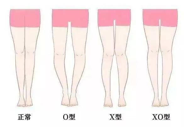 宝贝O型腿、X型腿?专家:不一定缺钙,也不能让纸尿裤背锅